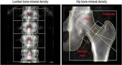 Relationship between bone mineral density and hyperuricemia in obesity: A cross-sectional study